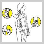 osteoporosis-Illustration